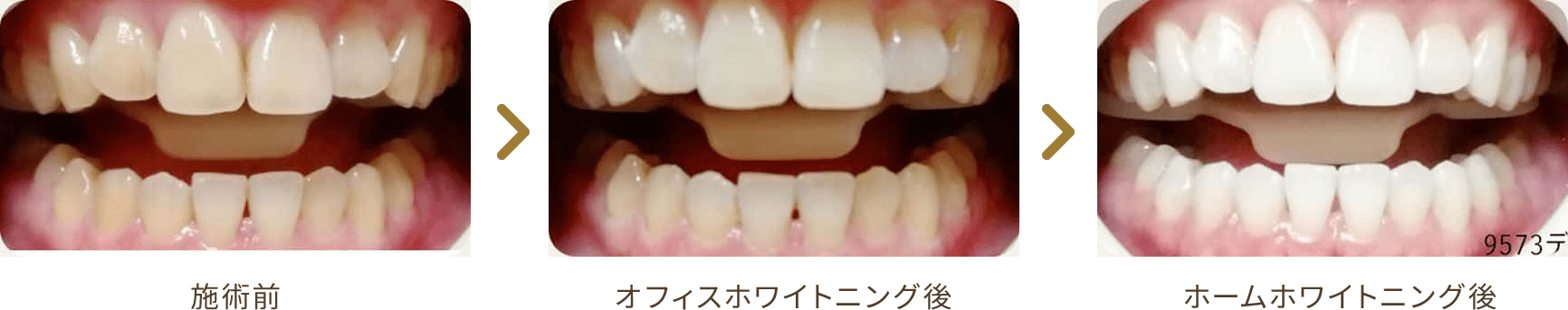 デュアルホワイトニングのBefore