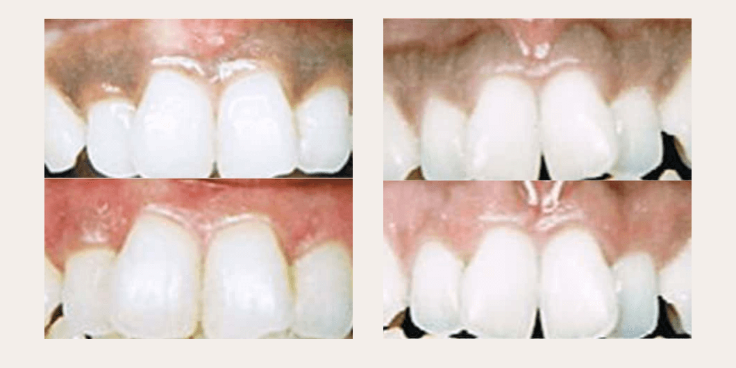 色素沈着してしまった歯茎